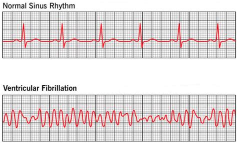Ventricular Fibrillation Prediction and Detection: A Comprehensive ...