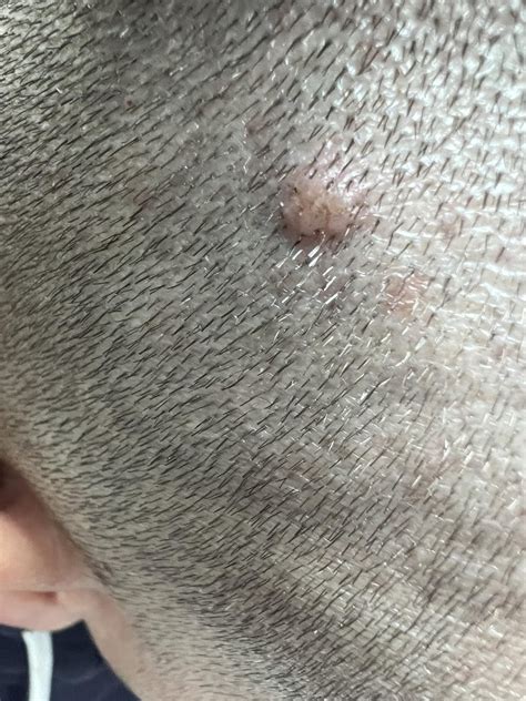 What are these bumps on my head? I have at least 3 : r/DermatologyQuestions