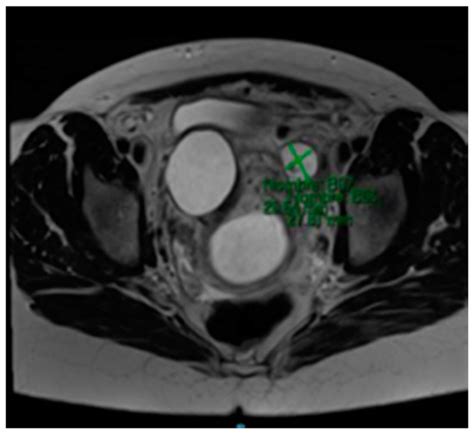 Medicina | Special Issue : Minimally Invasive and Fertility-Sparing ...