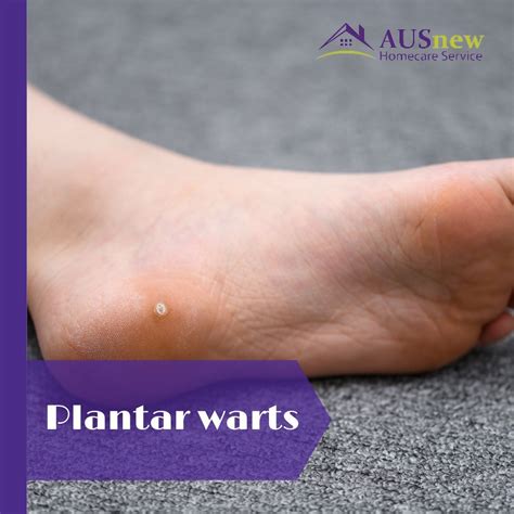 Plantar Wart Natural Treatment at James Vanhorn blog