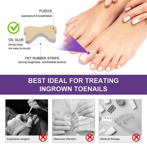 Ingrown Toenail Treatment Kit | Pain Relief Tool for Easy Trimming | Soften Nails & Straighten ...