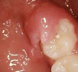 Image result for Treatment of Pericoronitis