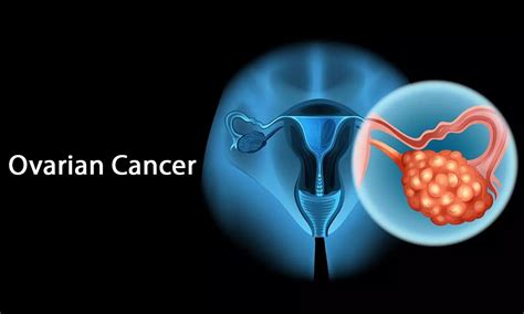 Photodynamic therapy useful option for treating metastatic ovarian cancer