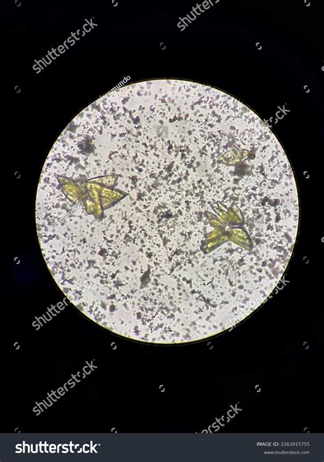 Amorphous Crystals In Urine Normal Range at Linda Landry blog