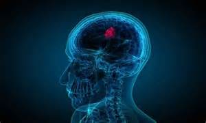 Nasal drops fight brain tumors noninvasively, states study