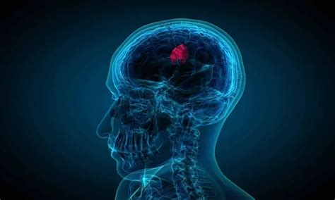 Nasal drops fight brain tumors noninvasively, states study