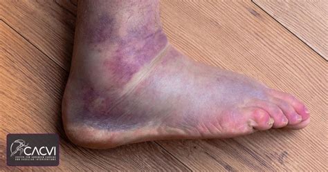 Poor Circulation Leg Sores 的图像结果