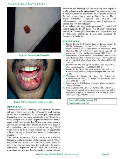 Extravasation Mucocele– A Case Report | PDF