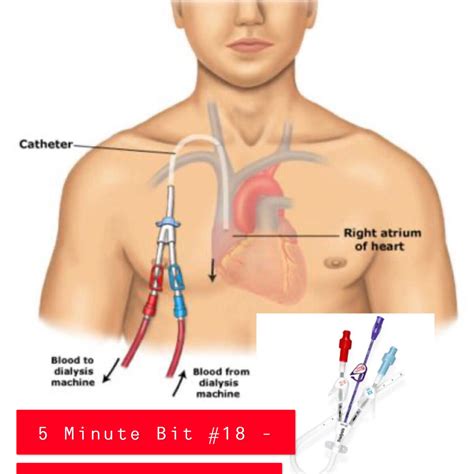 Temporary Hemodialysis Catheter