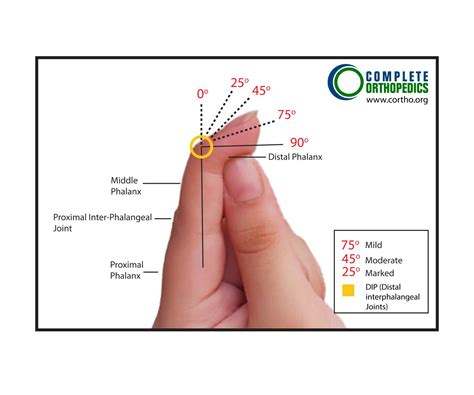 Upper Extremities – Thumb and Fingers | Best Hip & Knee Surgeon | NY, USA