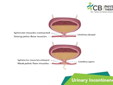 What Is Urinary Incontinence?, Symptoms, Causes, Diagnosis ...