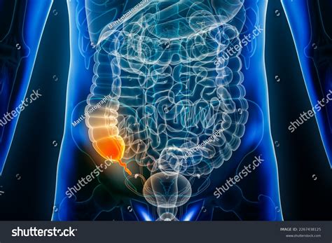 Image result for Appendix Inflammation