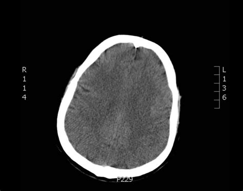 Image result for Normal Profile CT