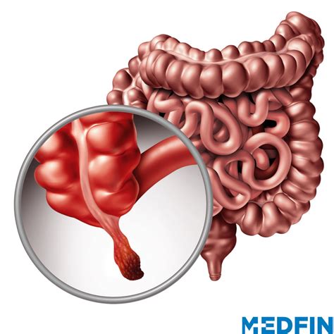 Appendicitis – Causes, Symptoms And Prevention