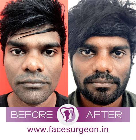 Guide To Nose Reduction Or Rhinoplasty Surgery In India – Richardson's Plastic Surgery Hospitals
