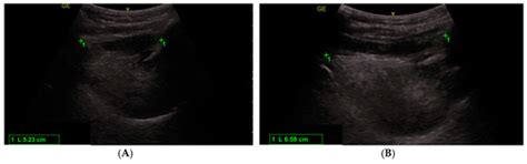 Clinical versus Ultrasound Measurements of Hyomental Distance Ratio for ...