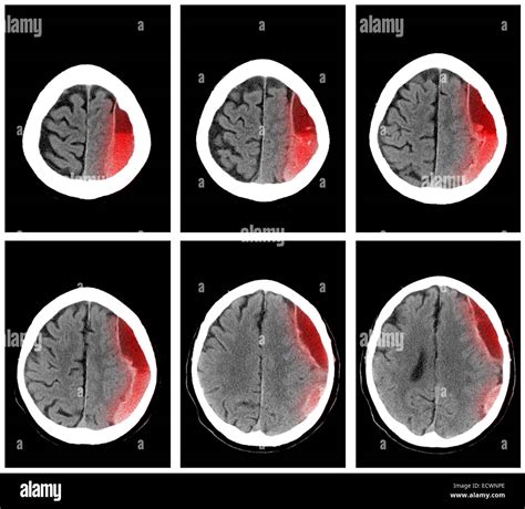 CT scan of the head showing a subdural hematoma Stock Photo - Alamy