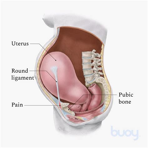 Inguinal Ligament Female Pain