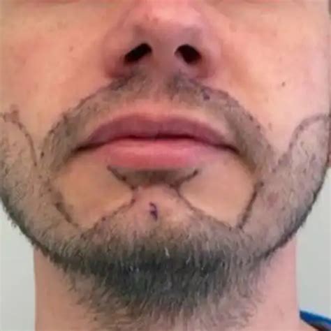 Beard And Moustache Transplant in Delhi, India | Facial Hair Transplant ...