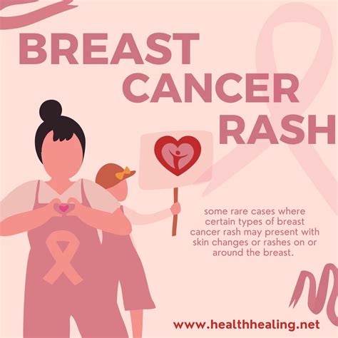 Breast_cancer_rash - 1 | Breast cancer typically does not pr… | Flickr