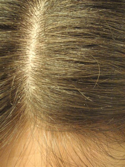 The difference between dandruff and a dry scalp