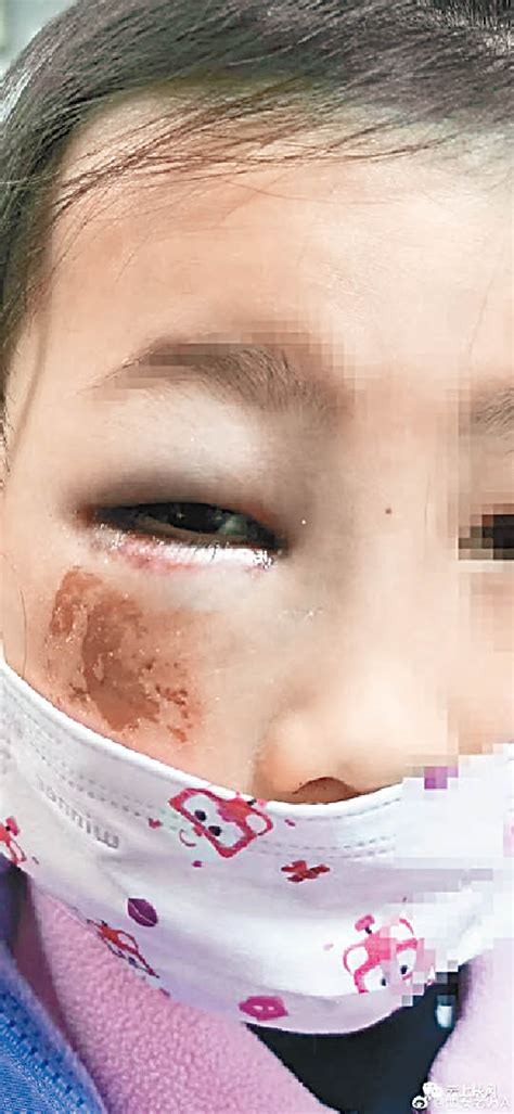 惡師體罰8歲女生險盲 - 東方日報