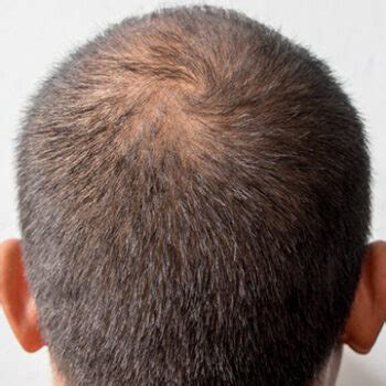Receding Hairline in Black Men | Dr. Ziya Yavuz