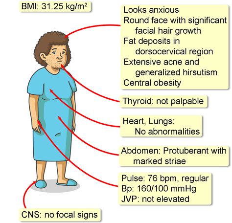 Pseudo-Cushing Syndrome - Interactive case study | Clinical Odyssey by ...