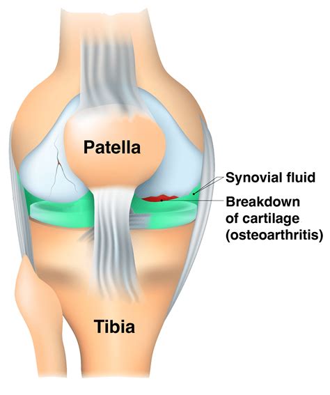 Gel Injections for Knees - Joint Relief Institute