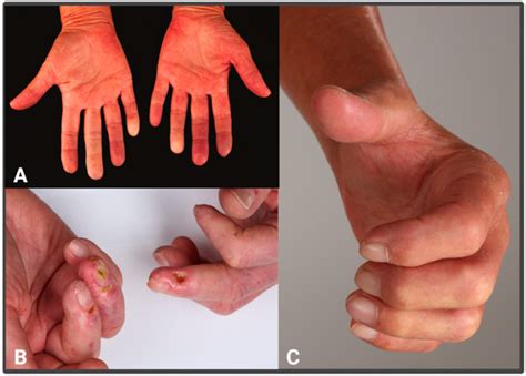 Pathophysiology in Systemic Sclerosis: Current Insights and Future ...