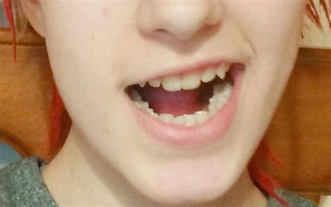 Rezultat imagine pentru Human Sharp Teeth