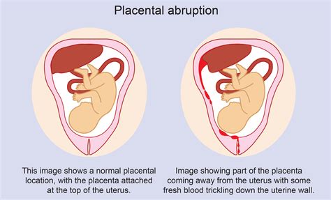 Placenta Previa Vs Abruptio