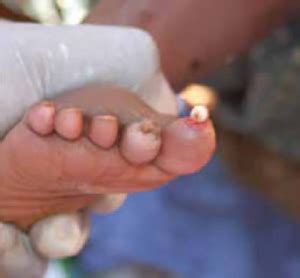 Image result for Jigger Bug Parasite