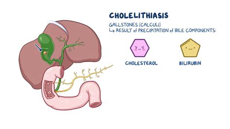Video: Cholelithiasis: Nursing | Osmosis