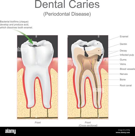 Dental caries is the scientific term for tooth decay or cavities. It is ...