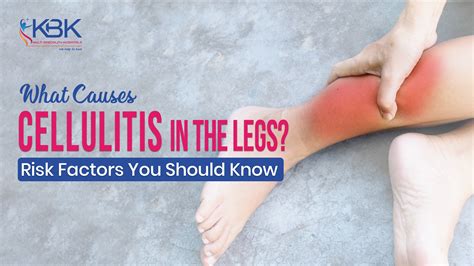 What Causes Cellulitis Of The Leg