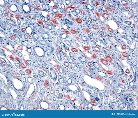 Human Kidney. Amyloidosis, Congo Red Stock Illustration - Illustration ...