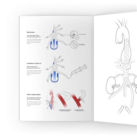 Vascular device | Instructions for Use Illustrations — Now Medical Studios