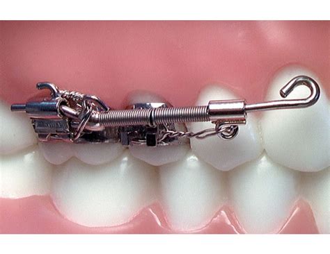 WHAT is DistaLizatioN IS ? — Teletype