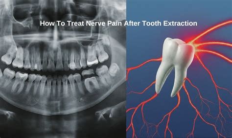 Image result for Tooth Extraction Pain Relief