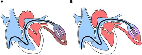 Pulmonary Artery Wedge Pressure Can Underestimate Direct Pulmonary Vein ...
