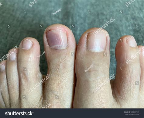 Subungual Hematoma Bleeding Under Toe Nail Stock Photo (Edit Now ...
