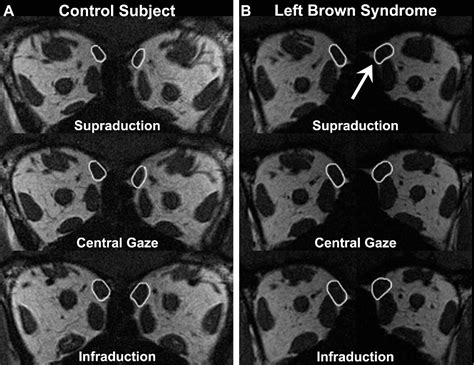 Brown Tendon Sheath Syndrome | Semantic Scholar