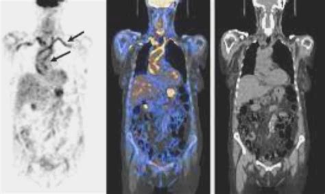 PET/CT helpful in diagnosing fever or inflammation of unknown origin: Study
