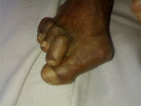TechieDoc: Rheumatoid arthritis- toes
