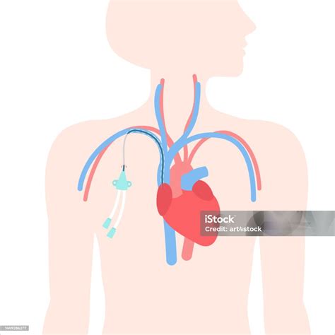 Tunneled Central Line Venous Catheter Medical Diagram Stock Illustration - Download Image Now ...