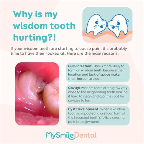 Impacted Wisdom Teeth Pain