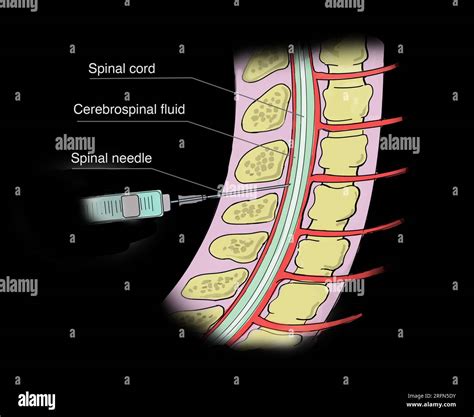 A lumbar puncture (spinal tap) is a test used to diagnose certain health conditions. It's ...
