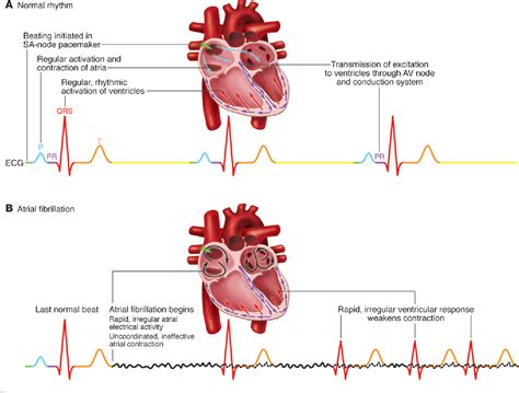 What Is Paroxysmal Atrial Fibrillation