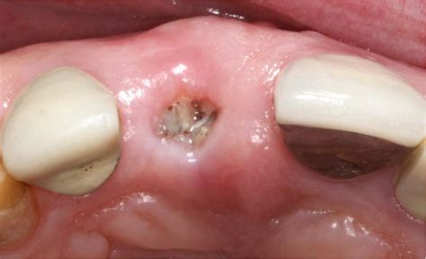 Image result for Tooth Extraction Scar Tissue